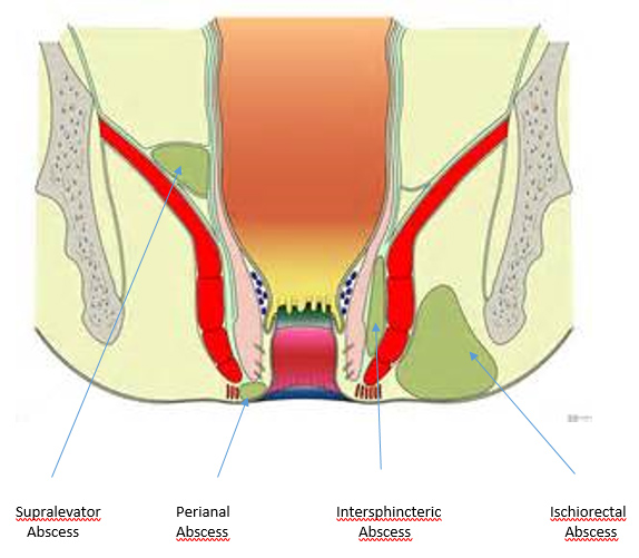 With perianal fistulas